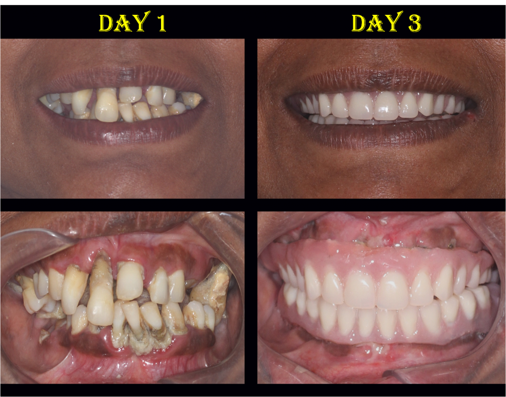 full mouth implants in 3 days